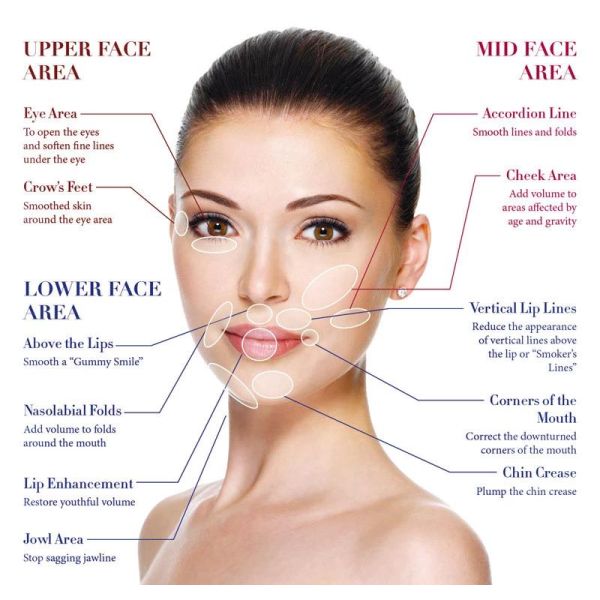 Поверхностное к глубокому лечению лица с неврамисом Дермальное наполнитель Отек побочные эффекты гарантированы