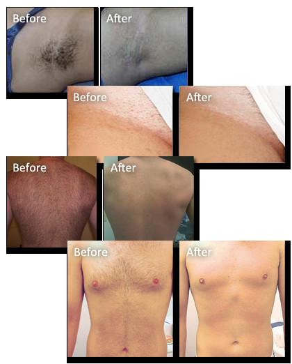 Most Professional 2016 Best Diode Laser Hair Removal Machine for Sale!!