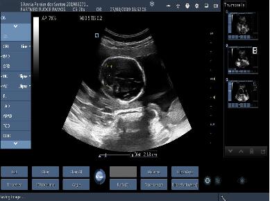 Transvaginal Handheld Portable Ultrasound Device Convex Linear Cardiac Probe Detachable