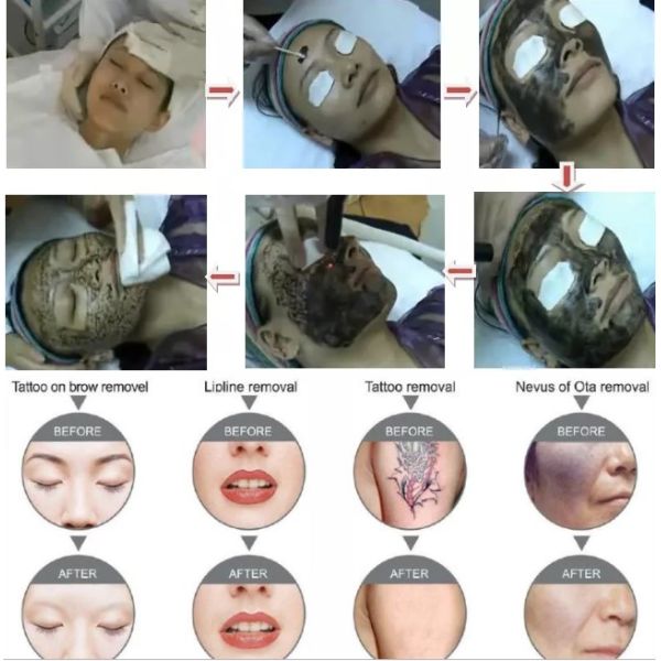 1064nm 532nm 1320nm Nd Yag équipement laser portable pour le blanchiment de la peau