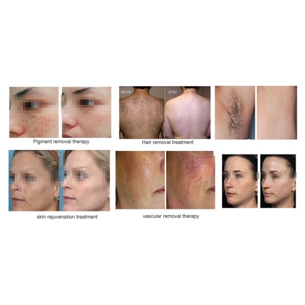 2000W Power IPL Laser Skin Rejuvenation Machine Vascular Removal High Repetition