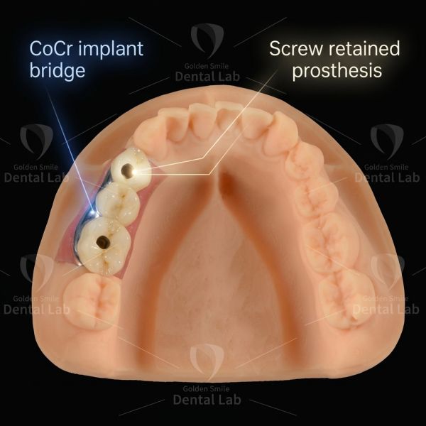 Implant Crown And Bridge China Dental Lab High Precision Digital Mapping