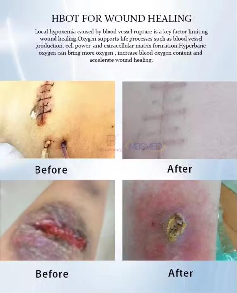 High Quality Hyperbaric Oxygen Chamber For Wound Healing Physical Therapy