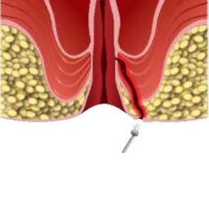 Dual Wavelength Laser 980nm 1470nm for Anal Fistula Hemorrhoid Proctology