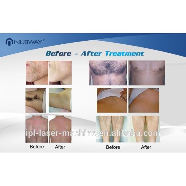 Best selling 808nm diode laser hair removal machine for sale