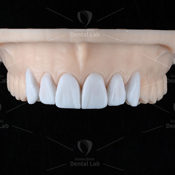 Dental Crown Wax Up Preparation Single Tooth Implants Diagnostic Waxup