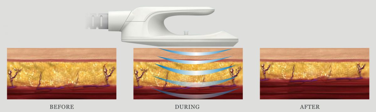 Машина стимулированием Ems уменьшения системы воздушного охлаждения 7 Tesla жирная