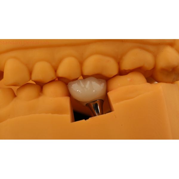 Screw Retained Dental Implant Crown Dental PFM Crown With 3D Print Model