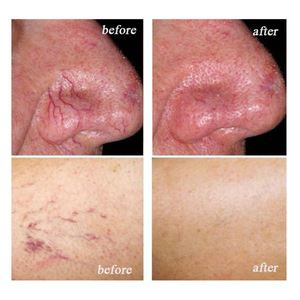 Blood Vein Hemangioma Removal Laser Beauty Equipment  Hospital Use CE Approved