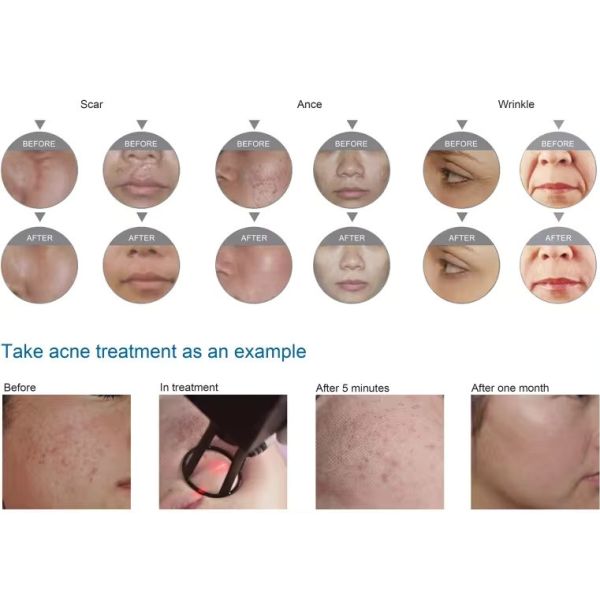 Continuous Interval Ultra Pulse RF Fractional CO2 Laser For Fractional Skin Resurfacing