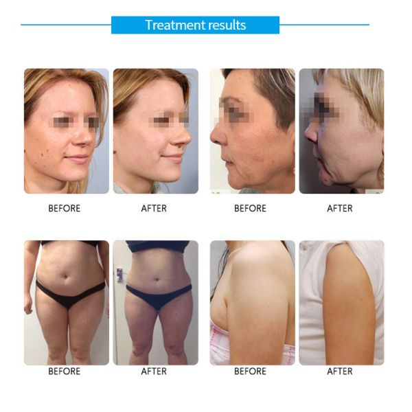 5 el salón facial Clini de la máquina de las manijas HIFU pela el ajuste