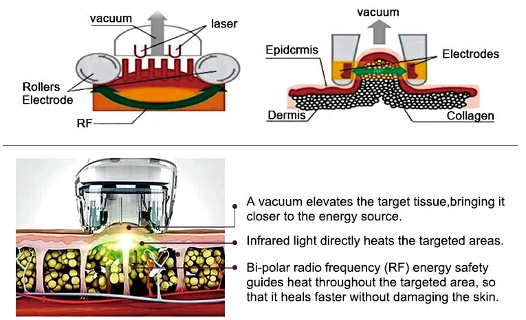 100кПа спа для похудения 1mhz RF кавитационная вакуумная терапия