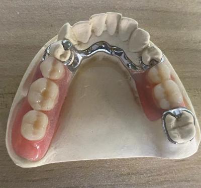 Reliable Silver Metal Frame Denture Corrosion Resistance With Customizable Design