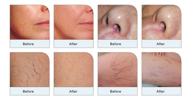 980nm Diode Laser Vascular Removal Machine / Spider Vein Removal Diode Laser Machine