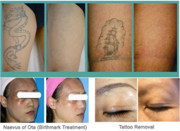 Medical Aesthetic Equipment Tattoo Removal Machine Q - Switched Nd YAG Laser