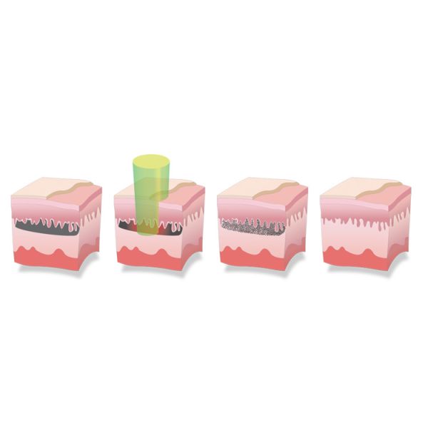 Q Switched Nd Yag Laser Pico Laser Tattoo Removal Machine 1064nm 532nm