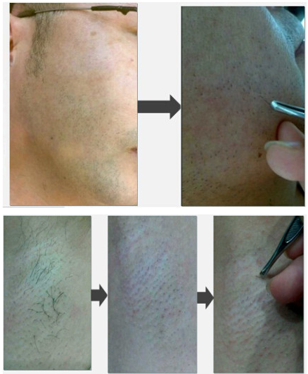 LCD Touch 810nm Diode Laser Depilation Equipment For Commercial