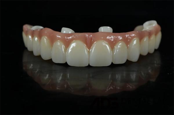 Biocompatible Titanium All On 6 Dental Implants Bridge For Tooth