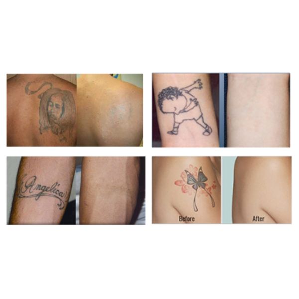 Professional ND YAG Laser Tattoo Removal Machine For Eyebrow Tattoo Removal