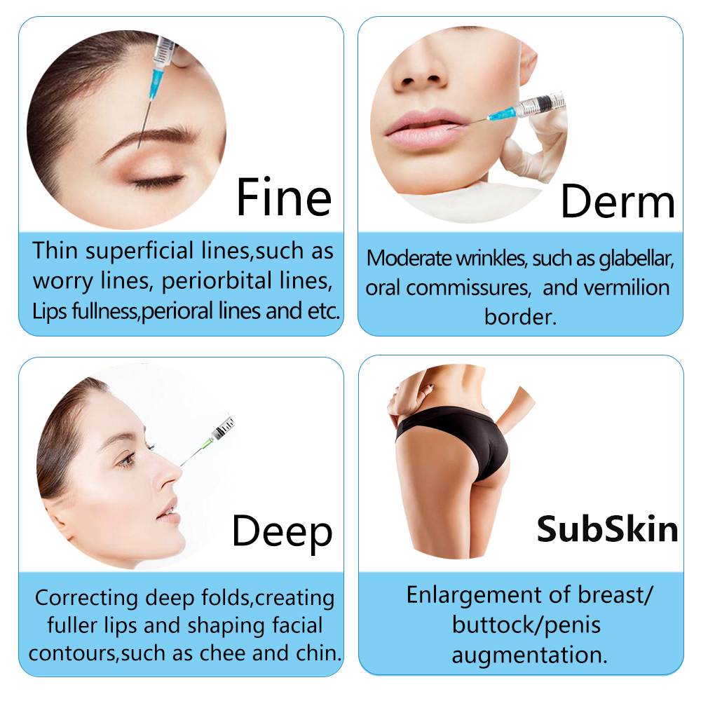 линия нос 2ml Fosyderm глубокая формируя заполнитель для лицевой пластмассы