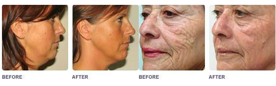 Multifunction Beauty  Devices SHR IPL SHR Hair Removal Machine