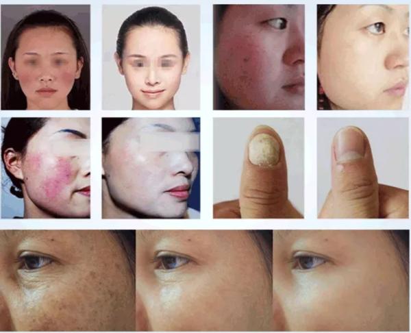 50W 980 Nm Diode Laser Spider Vein Removal Machine For Blood Vessel Treatment Solution