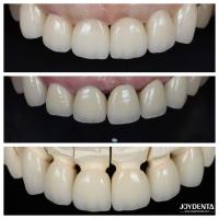 Excellente biocompatibilité Les facettes de porcelaine dentaire n'ont pas besoin d'être préparées