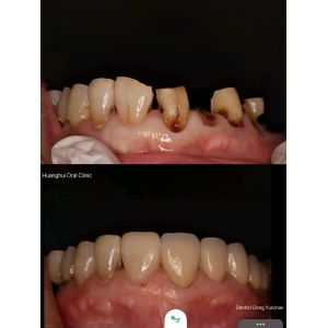 Coronas de Zirconia Premium para los laboratorios dentales globales.