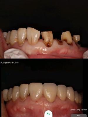 Zirconia dentures that imitate natural teeth