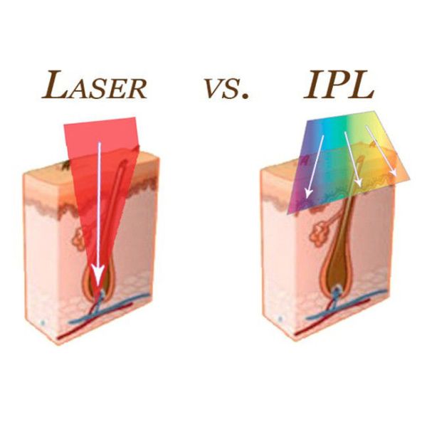 Машина удаления волос IPL 1000000 съемок