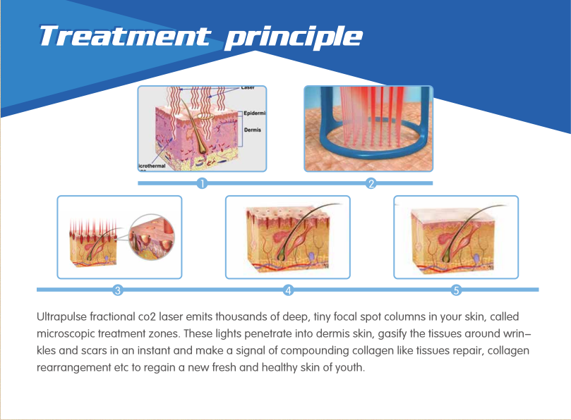 Big Discount Fractional CO2 Laser machine for Vaginal Tighten, Scar Wrinkles Removal Skin Resurfacing with 3 warranty