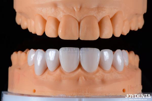 Custom Made Dental Emax Ceramic Veneers With Stain Resistance High Gloss