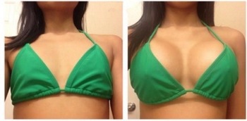 Заполнитель груди Хялуроник кислоты личной заботы 10мл для увеличения размера груди