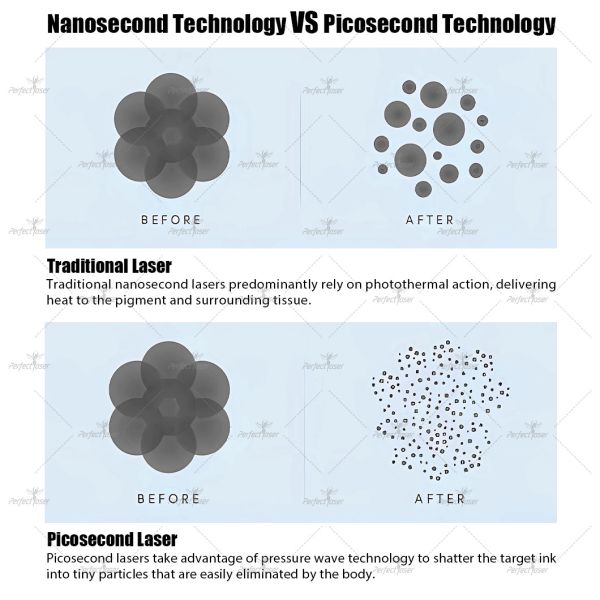 Professional Picosecond Laser Tattoo Removal Machine with Nd.yag Laser and 2000w Power