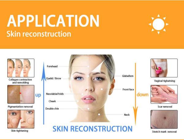 400mj CO2 Fractional Laser Machine 60W female intimate areal Rejuvenation Machine