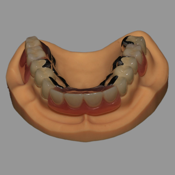 CoCr Acrylic Cast Metal Partial Combined With Fixed PFM