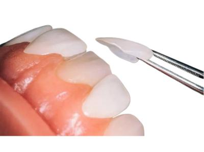 Custom OEM Dental Porcelain Veneer Firm Wear Resistant For Dental Restoration