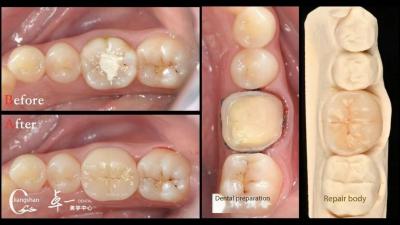 Biocompatibility And High Compatibility With Natural Teeth Restoration Dental Inlay Restorative