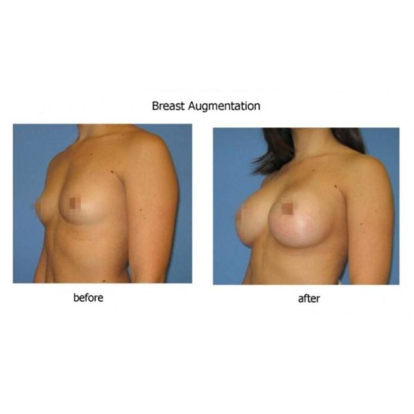 Заполнитель 10мл груди Хялуроник кислоты, заполнитель впрыски увеличения груди женщин