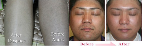 удаление волос лазера для машины удаления волос лазера светлых волос личной