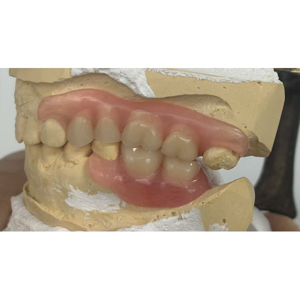 Removable Denture with Lingual Bar Retention for High Precision Fit and Conservative Tooth Preservation