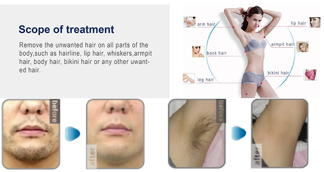 portable home use OPT IPL electrolysis hair removal