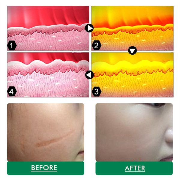 лазер СО2 40W Resurfacing ISO обработки машины влагалищный