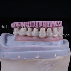 Dental Lab Durability Implants Make Cost-Effective Option in The Long Run