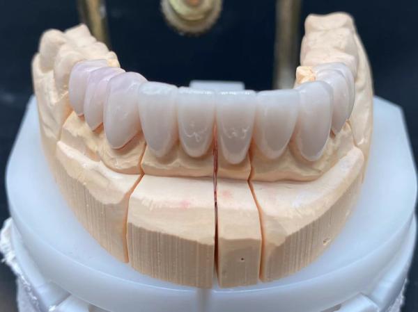 Dental Lab E Max Ceramic Crown High Translucent with Corrosion Resistance