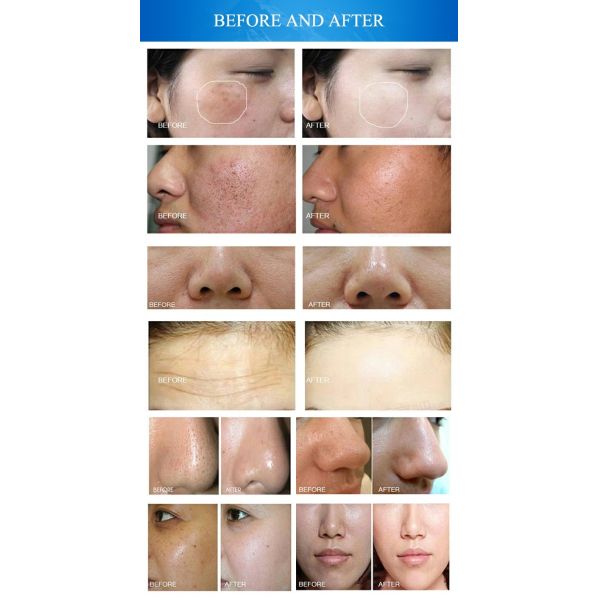 Красота 10 Microdermabrasion в 1 приборе корки кожи машины Hydrafacial