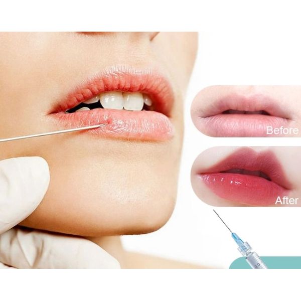 1 do instante profundo do enchimento de X 1.1ML Rejeunesse CE profundo ácido hialurónico do enchimento do enrugamento