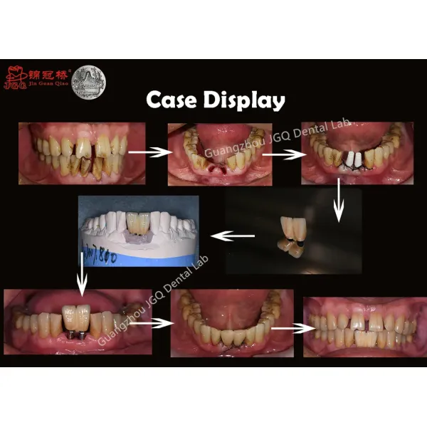 Permanent Restoration Full Contour Zirconia Crown Dental Implant with Custom Milled Titanium Frame