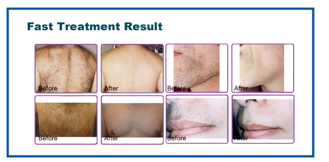 Professional Beauty Laser Hair Removal Equipment / Laser Diode Hair Removal Machine