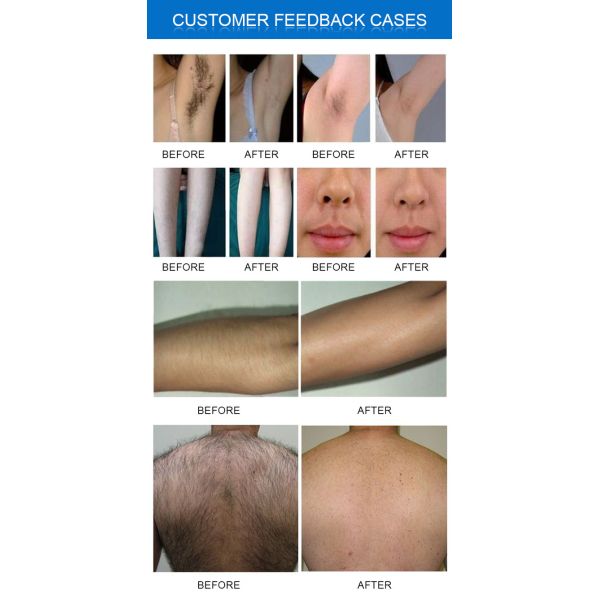 Triple Wavelength Laser Hair Removal Machine 755nm 808nm 1064nm With Wind Cooling System